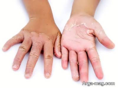 علت زبری پوست دست