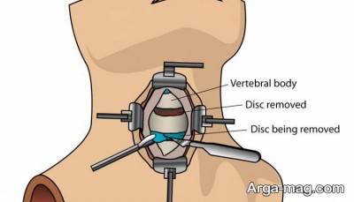 جراحی گردن از جلو