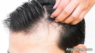 بیماری های کبدی مرتبط با ریزش مو 