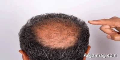 علت انجام کاشت مو چیست؟