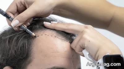 شرایط لازم برای کاشت مو چیست