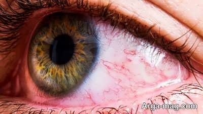 علت بروز بیماری فلوتر چشم
