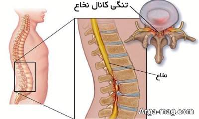 درمان خانگی تنگی کانال نخاع