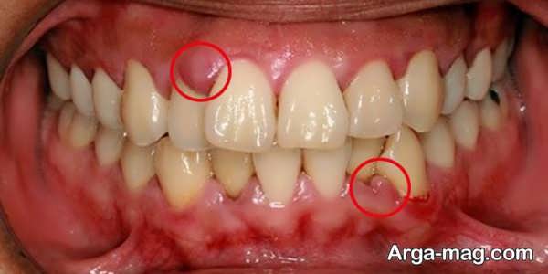 علل مهم آبسه دندان در حاملگی