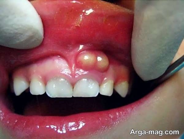 علائم آبسه دندان در دوران بارداری