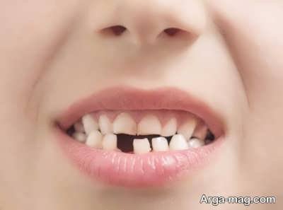 عارضه های از دست دادن دندان