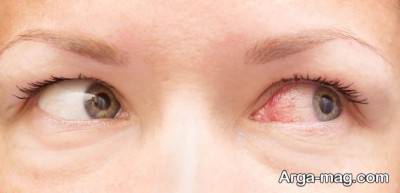 آسیب های عصبی چشم می تواند منجر به ایجاد احساس شن در چشم شود.