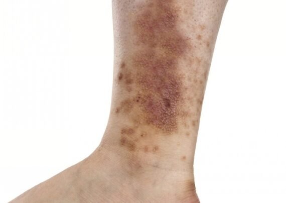 دلایل اصلی ایجاد لکه های تیره روی پا