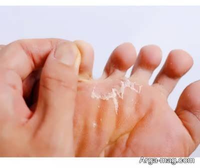 علت پوست شدن کف پا چیست؟