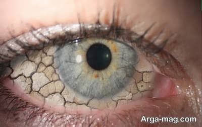 علل اصلی خشکی زیر چشم ها