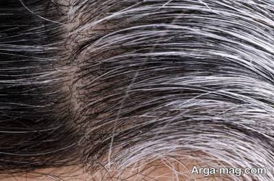 روش های درمان سفیدی مو