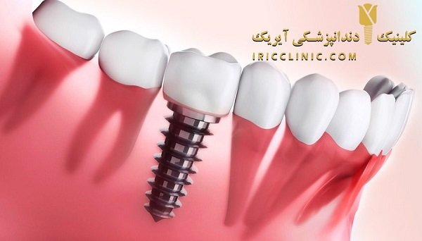 قیمت ایمپلنت دندان در تهران