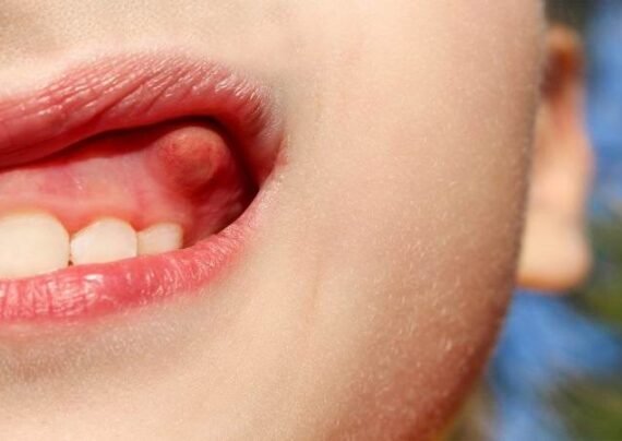 کیست دندان در کودکان چگونه است؟