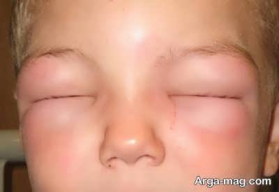 نشنانه های بیماری آنافیلاکتیک در کودکان