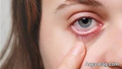 درمان چشم صورتی 