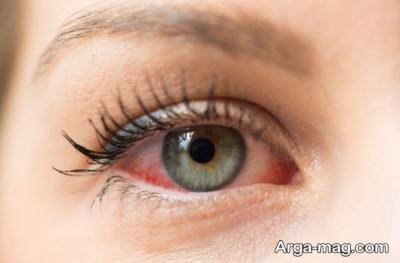 معرفی بیماری هایفما چشم چیست؟