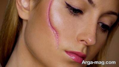 جراحی پلاستیک جای بخیه شکم