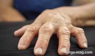 درمان آرتروز در علم پزشکی 