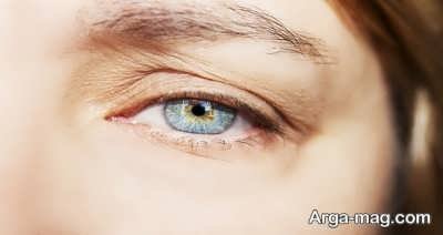 درمان پتوز چشم