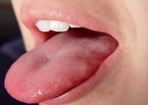 درمان التهاب زبان در خانه