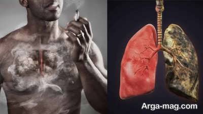 Lung emphysema disease 30
