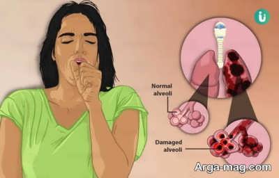 Lung emphysema disease 5
