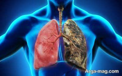 Lung emphysema disease 6