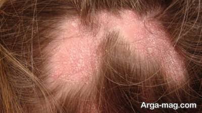 علائم عفونت فولیکولیت پوست و مو