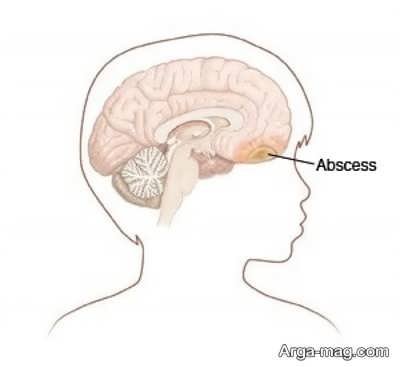 Treatment of brain abscess 12