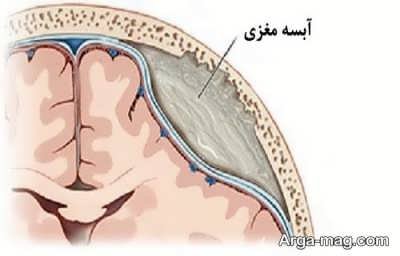 Treatment of brain abscess 8