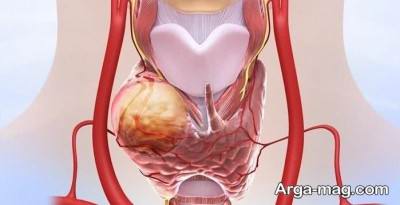 آشنایی با روش درمان ندول تیروئید