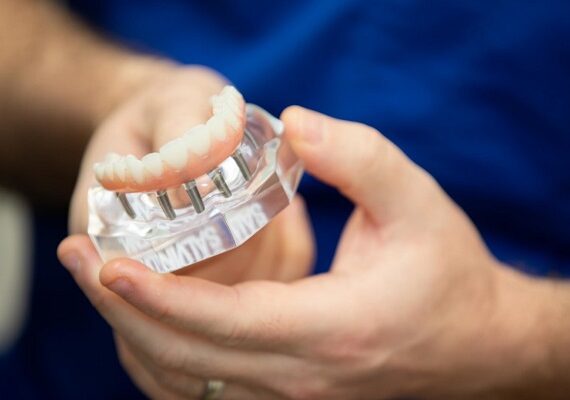 مراقبت از ایمپلنت دندان برای افزایش طول عمر آن