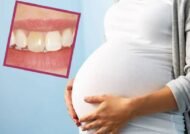 اهمیت سلامت دندان در بارداری