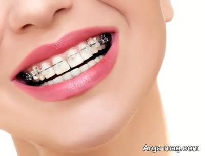 استفاده از ارتودنسی برای درمان مشکلات دندان