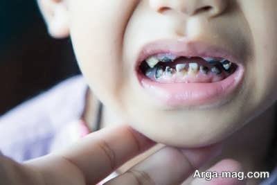 پیشگیری از سیاهی دندان