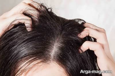 راهکار های جلوگیری از خشکی پوست سر