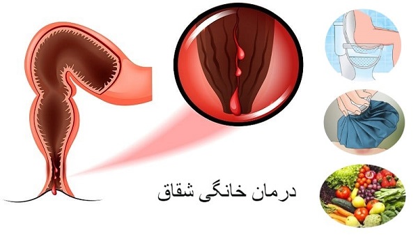 آیا شقاق یا زخم مقعدی خود به خود بهبود می‌یابد؟