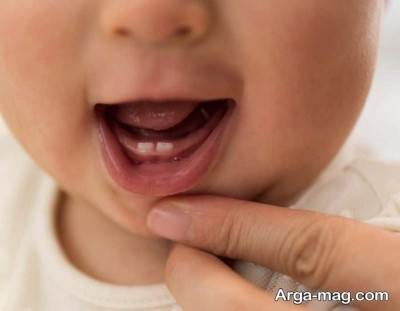 بیان مشکلات تولد کودک با دندان