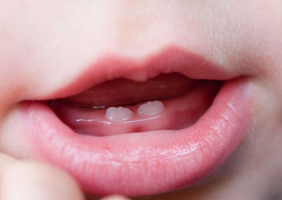 عوارض تولد نوزاد با دندان