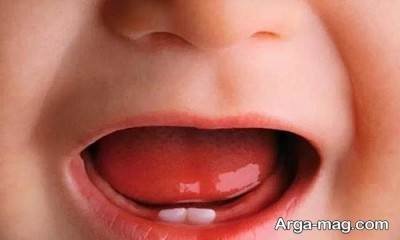 بررسی مشکلات تولد نوزاد با دندان