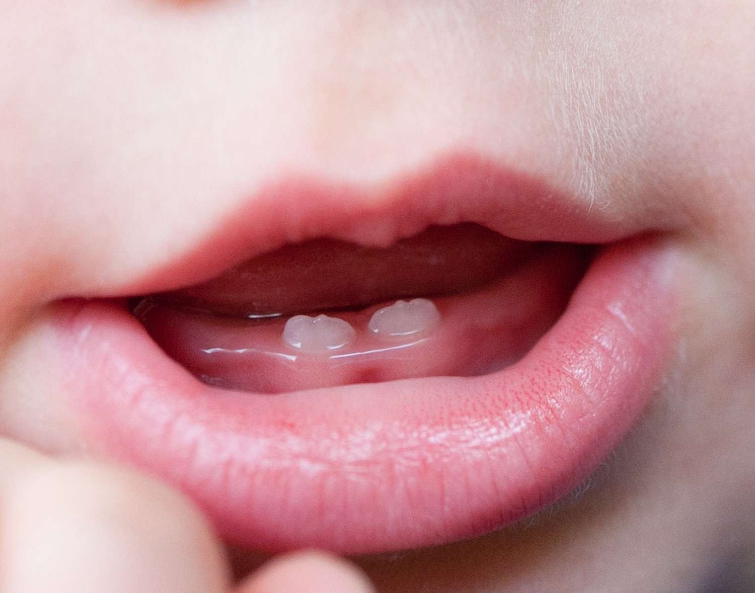 عوارض تولد نوزاد با دندان