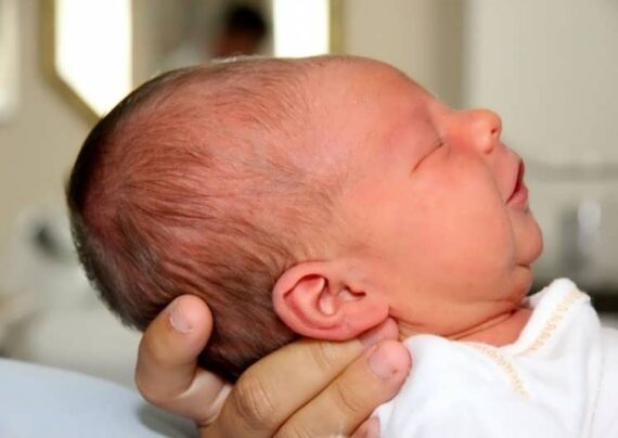 شکل مخروطی سر نوزاد چیست؟