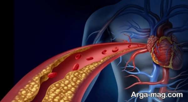 سخت شدن رگ ها در آترواسکلروز
