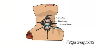 بررسی انواع درمان آرتروز گردن
