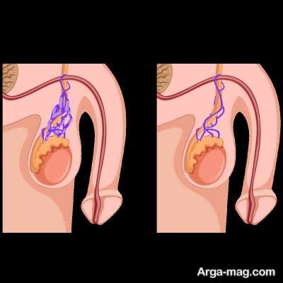 مشکلات واریکوسل و ناباروری