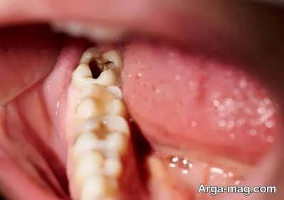 Treatment of tooth decay with traditional medicine 20