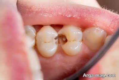 Treatment of tooth decay with traditional medicine 3