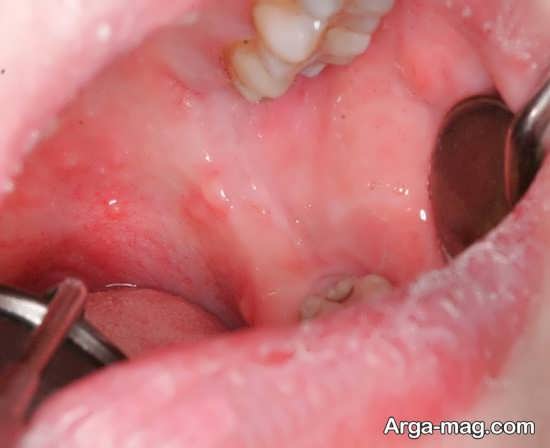 درمان تورم سقف دهان در منزل