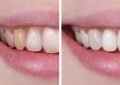 علت خرابی مینای دندان