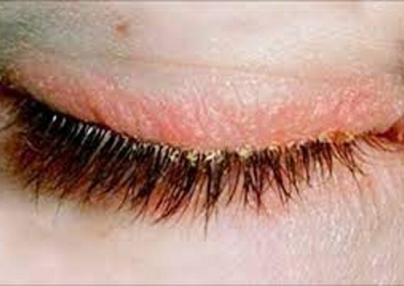 بررسی روش های درمان شوره مژه